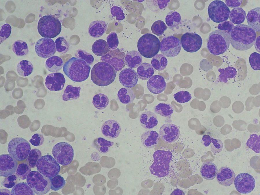 Leucemia mieloide cronica (LMC)