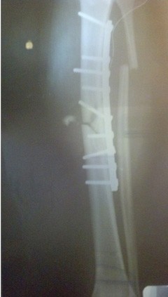 Courtesy of Bobby Dezfuli 

A post surgical x-ray of the broken shin bone. The surgical team cleaned the wound and realigned the bones with a stabilizing plate and screws. X-rays are typically used during surgeries like this in the US, however the team did not have access to one due to the limited resources of the hospital. 