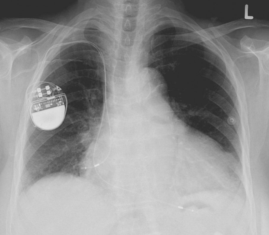 An x-ray of the thorax with a pacemaker. Computer hackers have the potential ability to remotely commandeer devices such as pacemakers.