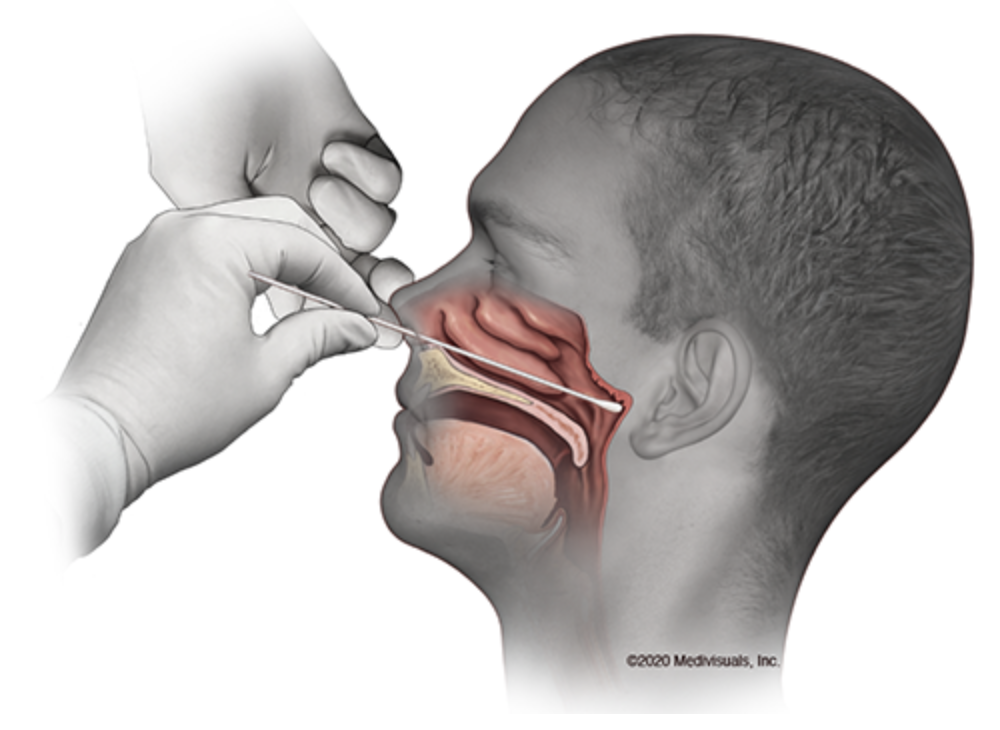 Most diagnostic testing for COVID-19 involves a swab to the back of the throat through the nose.

Source: UC Davis Health, MedVisuals